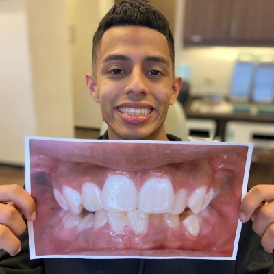 Teen Braces Before & After